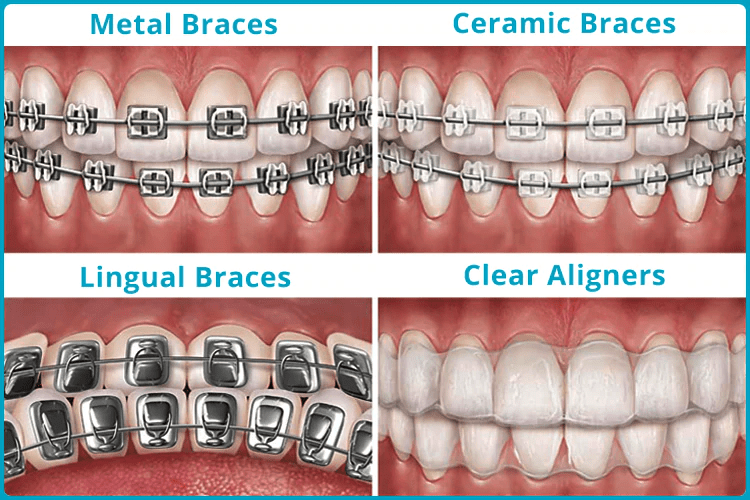 Clear Braces vs. Metal Braces, Frazer Dental Care, Dentist