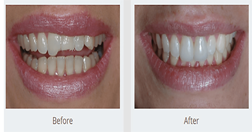 Dental Implants In Anand