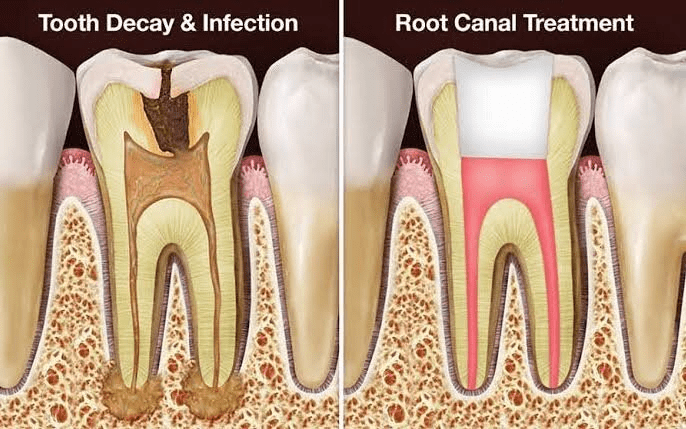 Fix Teeth Treatment in Anand